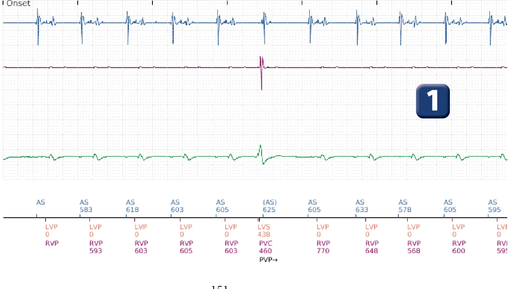 Boston Scientific ICD electrogram, segment 1 of 16 — Anti-tachycardia pacing in the VT zone and post-detection duration