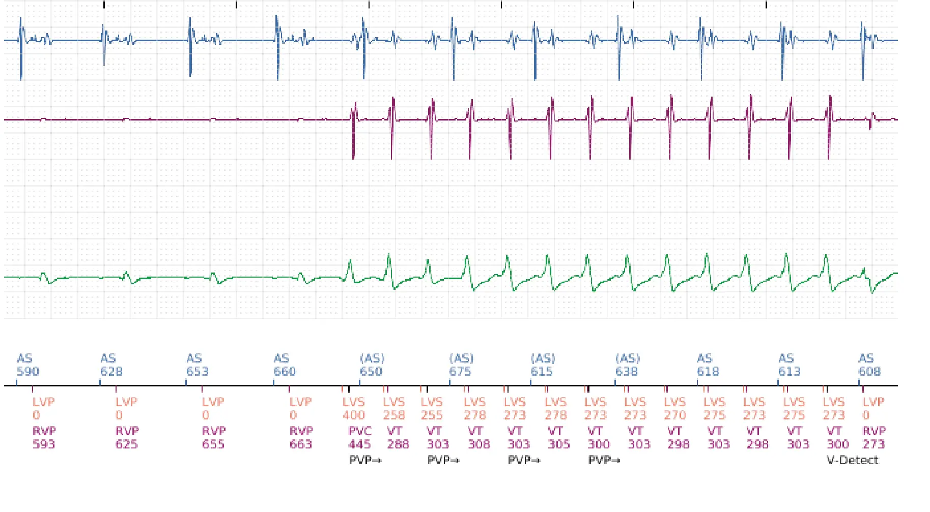 Boston Scientific ICD electrogram, segment 12 of 16 — Anti-tachycardia pacing in the VT zone and post-detection duration