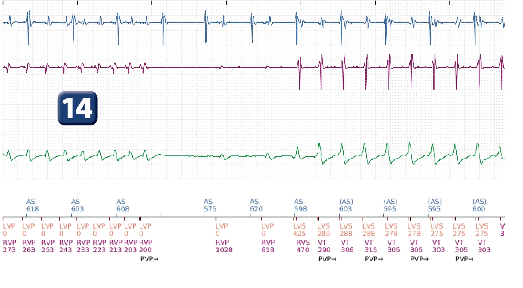 Boston Scientific ICD electrogram, segment 13 of 16 — Anti-tachycardia pacing in the VT zone and post-detection duration