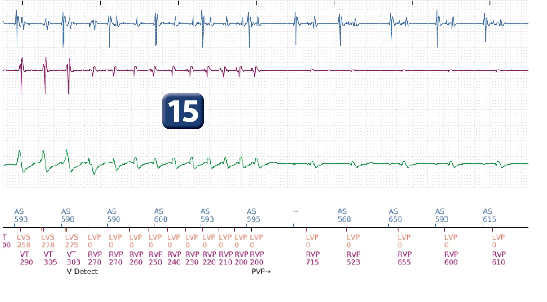 Boston Scientific ICD electrogram, segment 14 of 16 — Anti-tachycardia pacing in the VT zone and post-detection duration