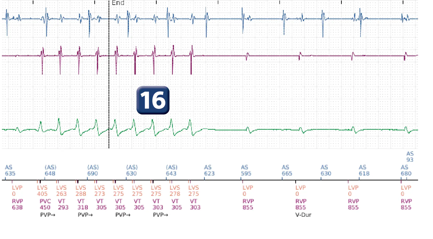 Boston Scientific ICD electrogram, segment 15 of 16 — Anti-tachycardia pacing in the VT zone and post-detection duration