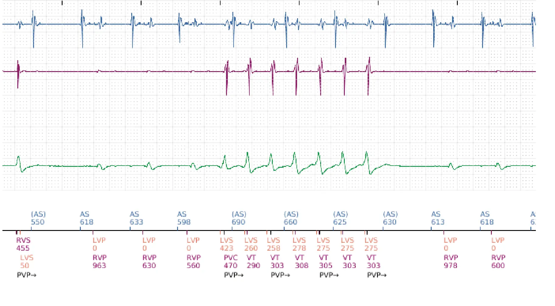 Boston Scientific ICD electrogram, segment 16 of 16 — Anti-tachycardia pacing in the VT zone and post-detection duration
