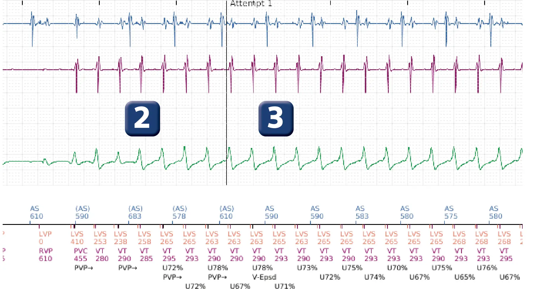 Boston Scientific ICD electrogram, segment 2 of 16 — Anti-tachycardia pacing in the VT zone and post-detection duration