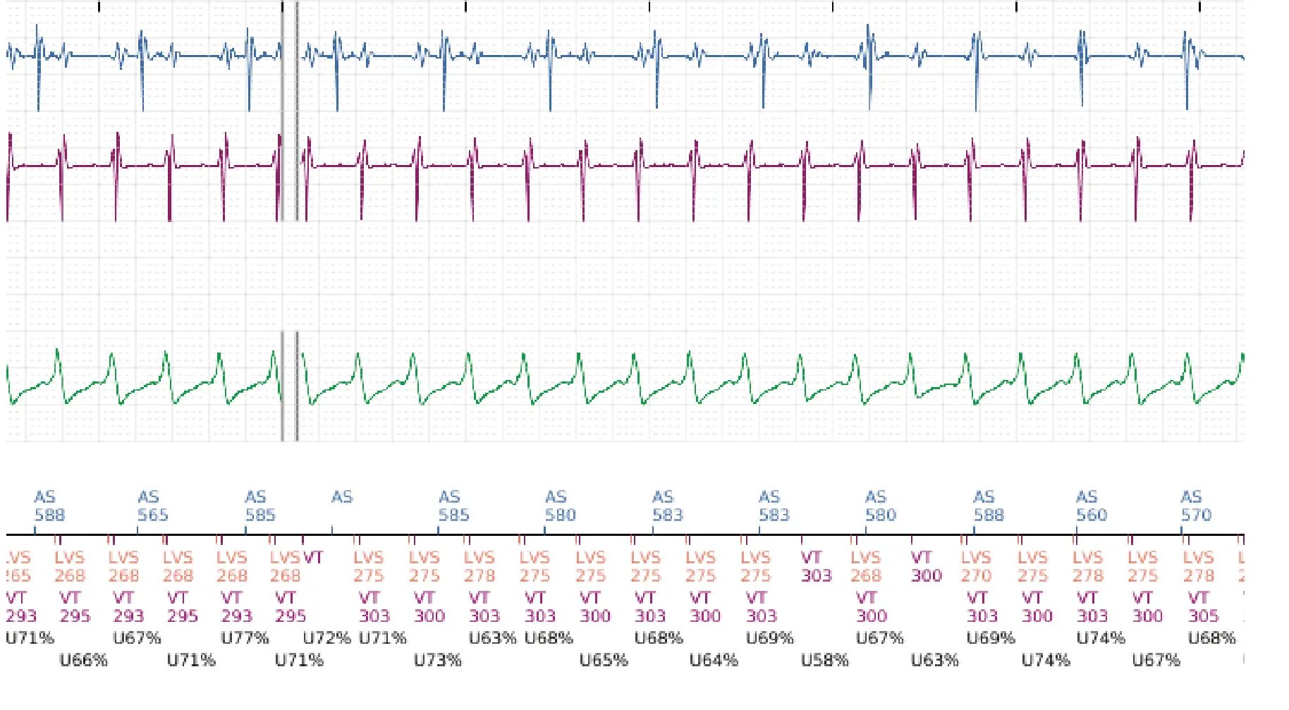Boston Scientific ICD electrogram, segment 3 of 16 — Anti-tachycardia pacing in the VT zone and post-detection duration