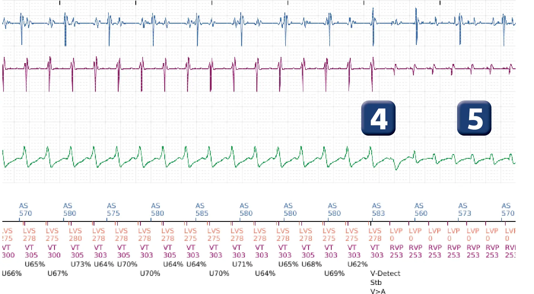 Boston Scientific ICD electrogram, segment 4 of 16 — Anti-tachycardia pacing in the VT zone and post-detection duration