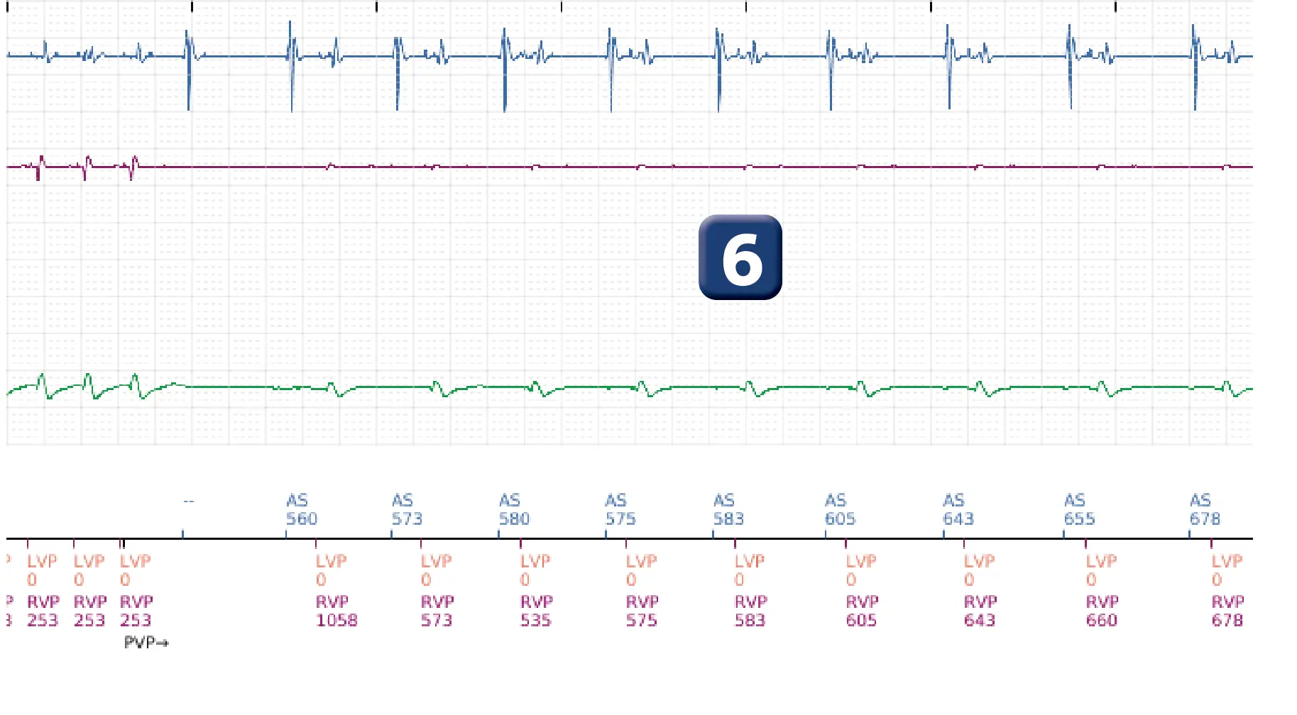Boston Scientific ICD electrogram, segment 5 of 16 — Anti-tachycardia pacing in the VT zone and post-detection duration