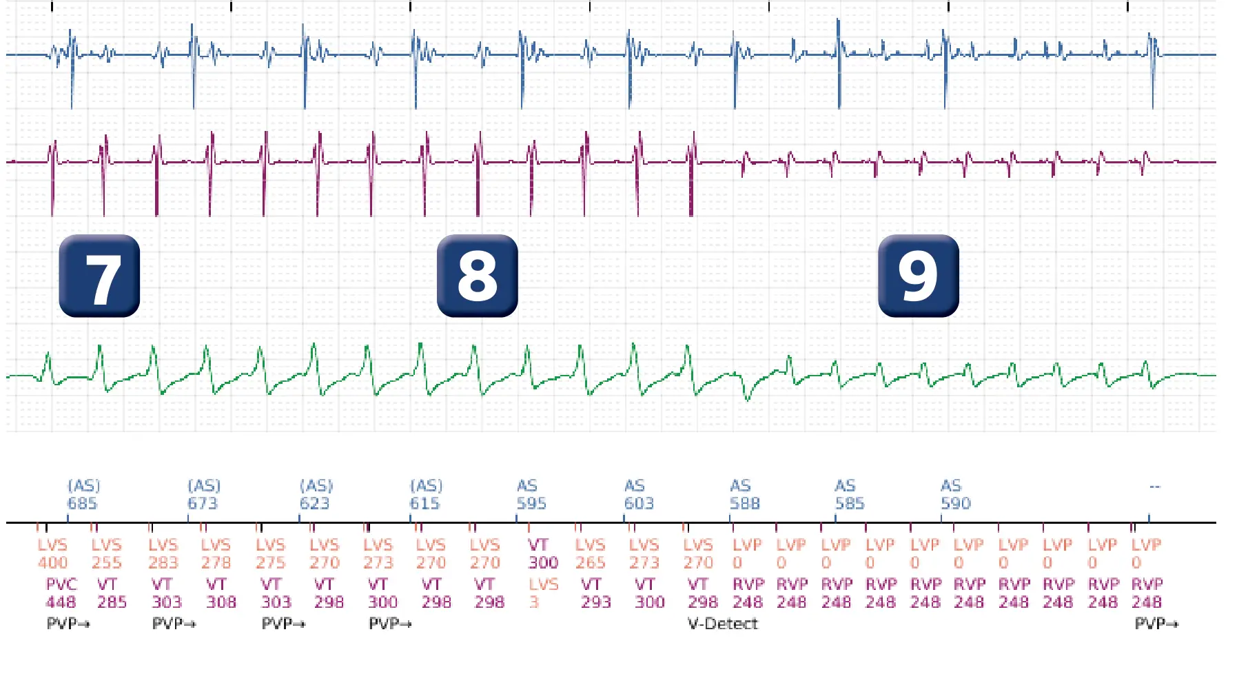 Boston Scientific ICD electrogram, segment 6 of 16 — Anti-tachycardia pacing in the VT zone and post-detection duration