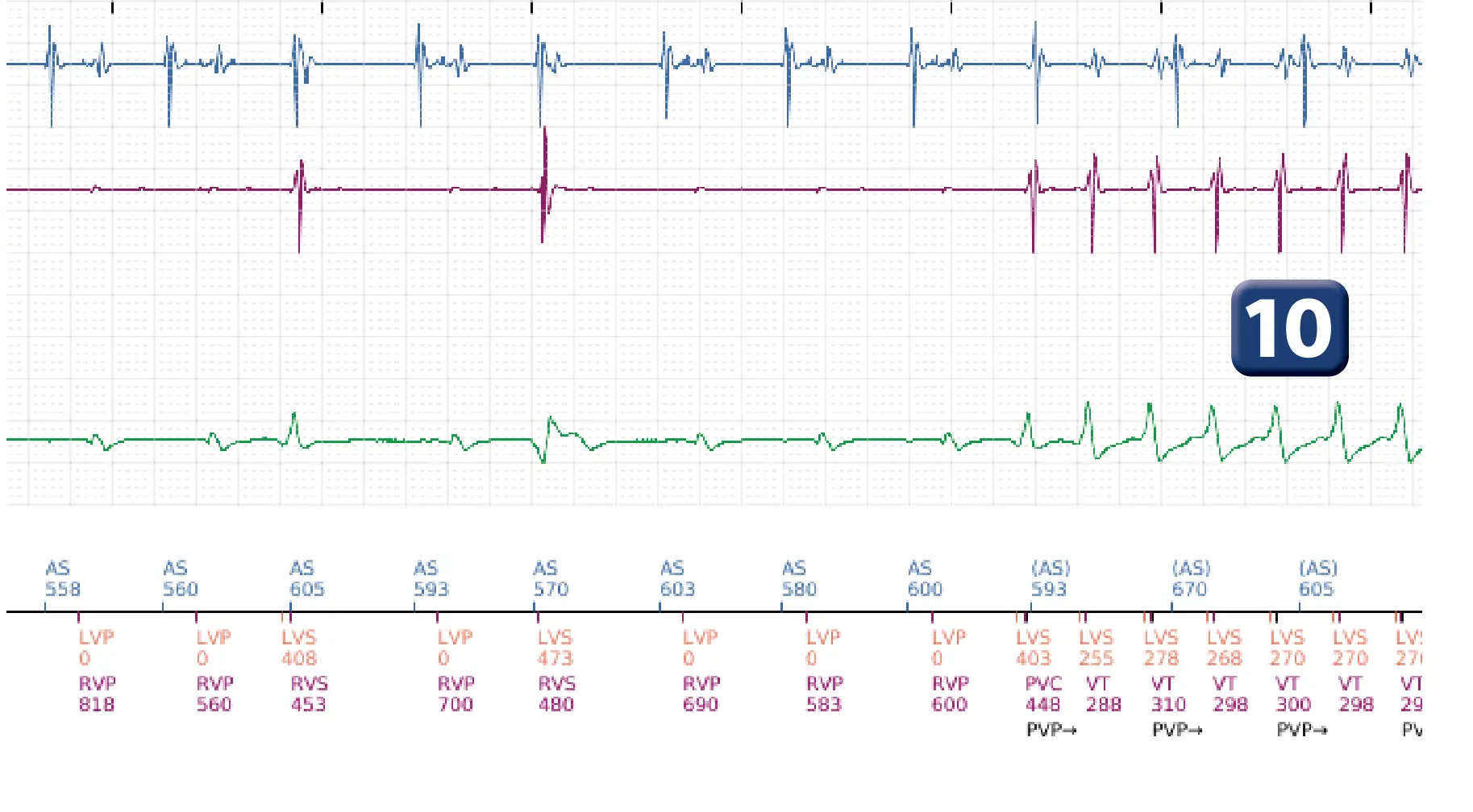 Boston Scientific ICD electrogram, segment 7 of 16 — Anti-tachycardia pacing in the VT zone and post-detection duration