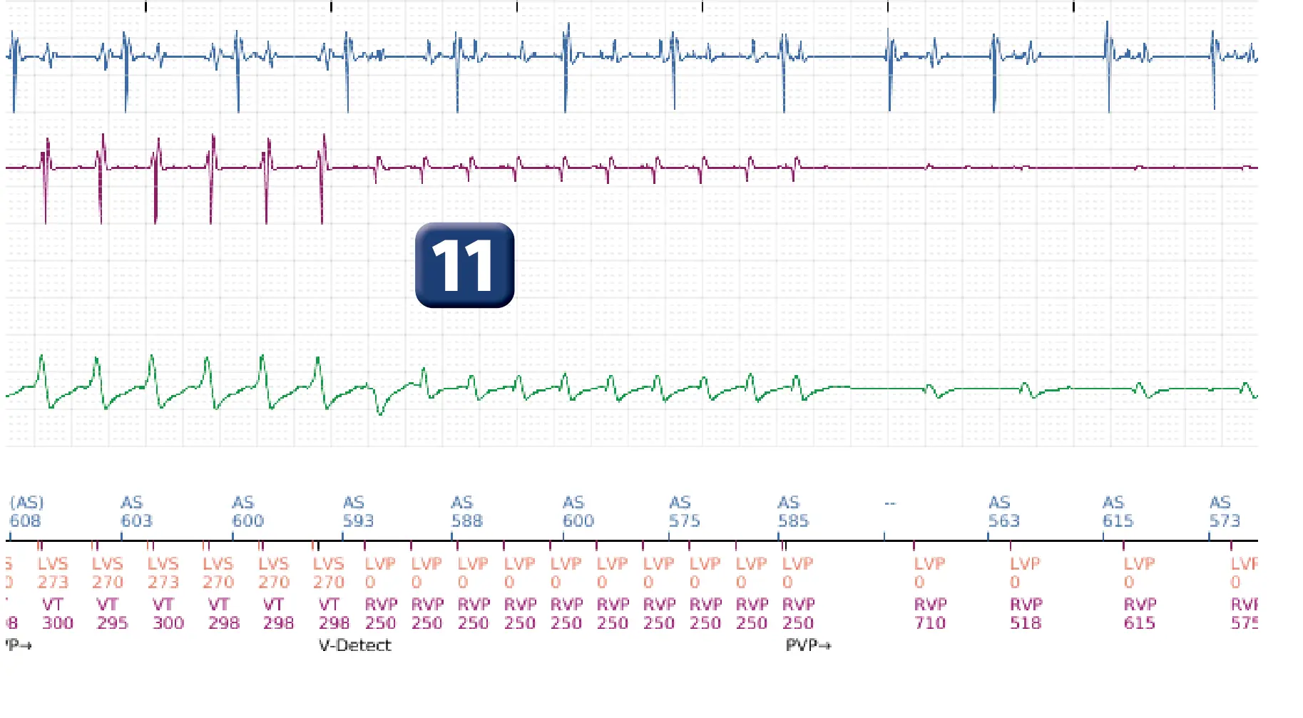 Boston Scientific ICD electrogram, segment 8 of 16 — Anti-tachycardia pacing in the VT zone and post-detection duration
