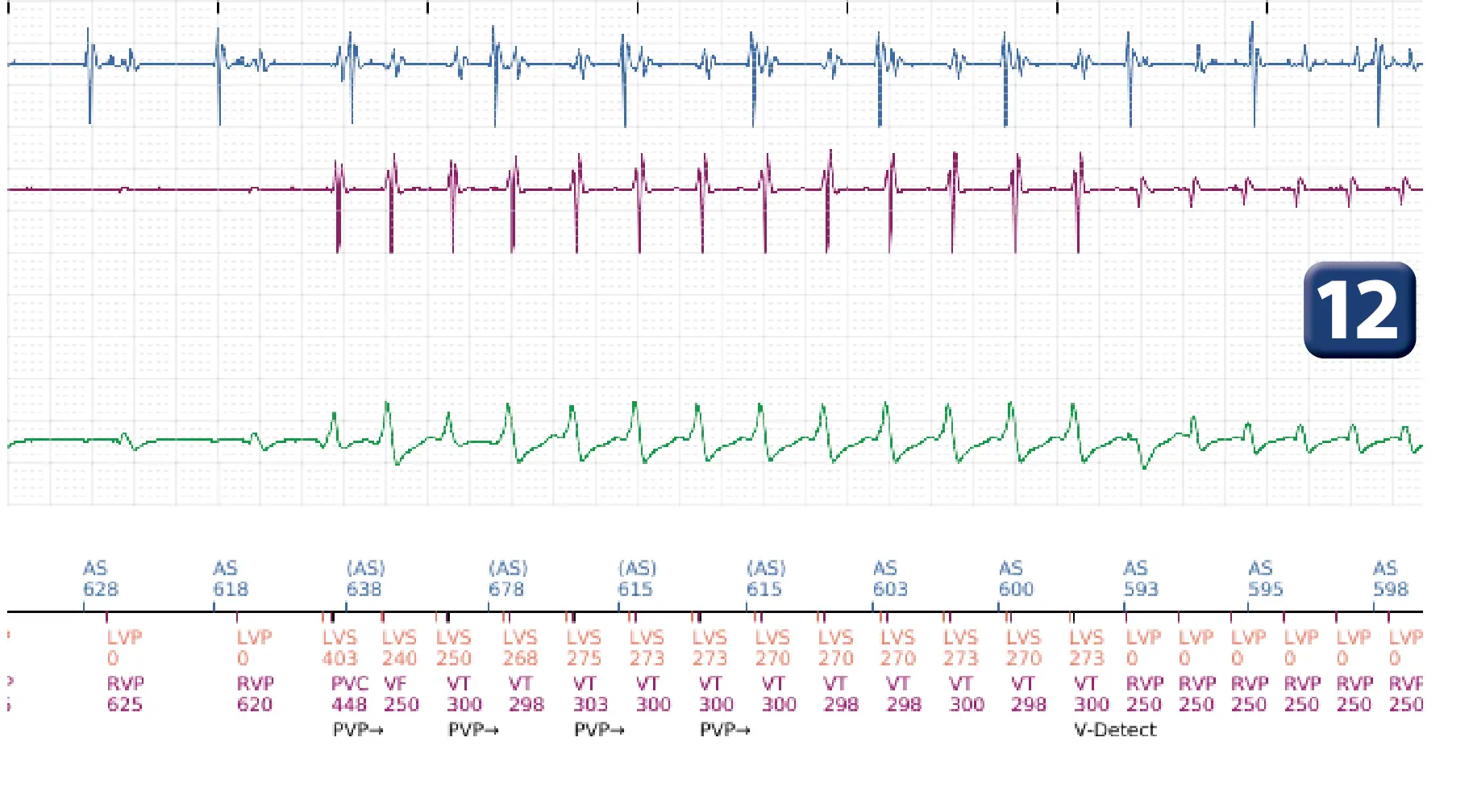 Boston Scientific ICD electrogram, segment 9 of 16 — Anti-tachycardia pacing in the VT zone and post-detection duration