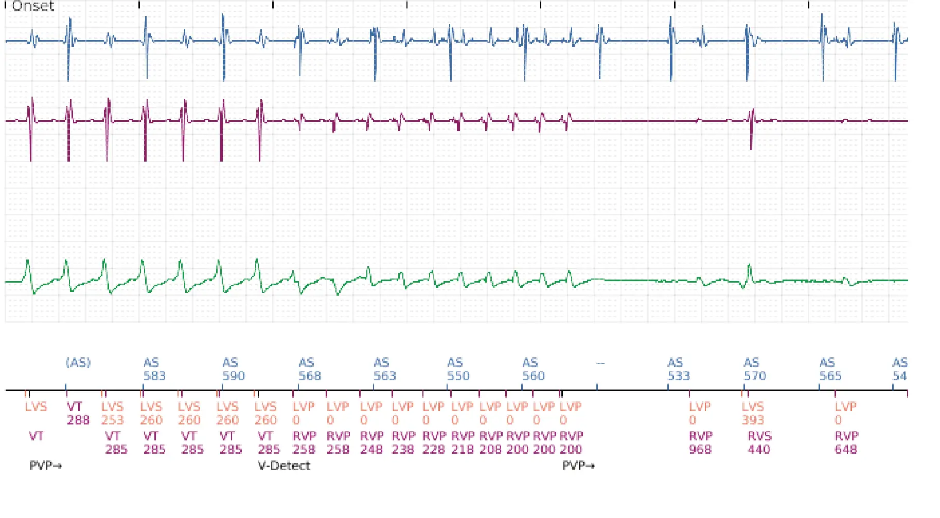 Boston Scientific ICD electrogram, segment 1 of 16 — Progression of therapies in the VT zone