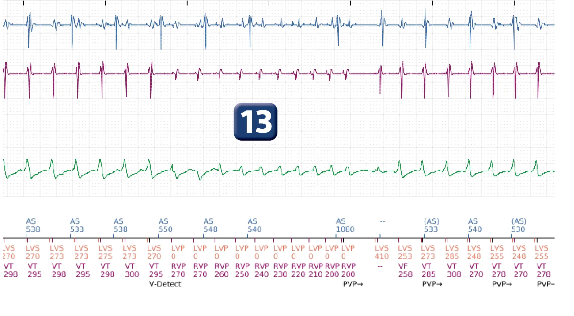 Boston Scientific ICD electrogram, segment 10 of 16 — Progression of therapies in the VT zone