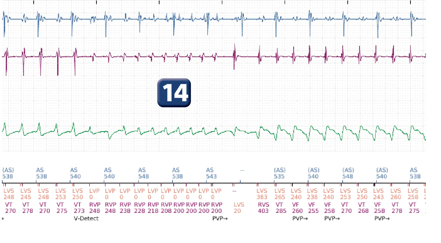 Boston Scientific ICD electrogram, segment 11 of 16 — Progression of therapies in the VT zone