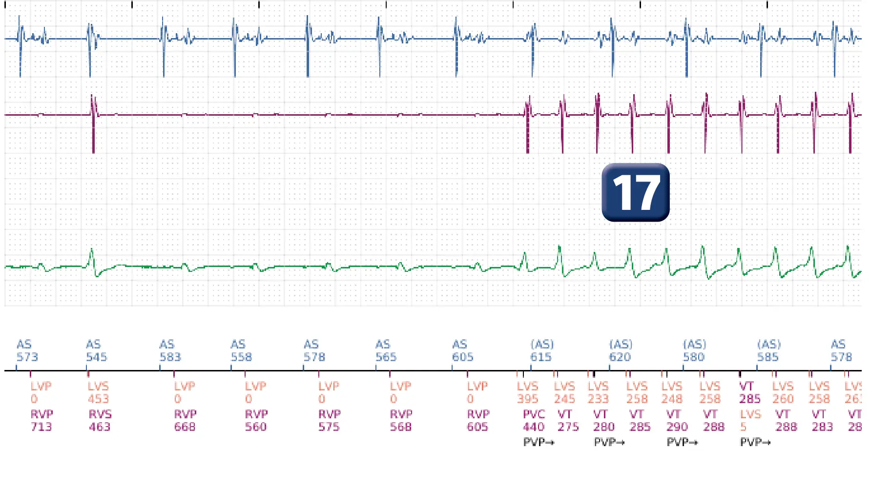 Boston Scientific ICD electrogram, segment 13 of 16 — Progression of therapies in the VT zone