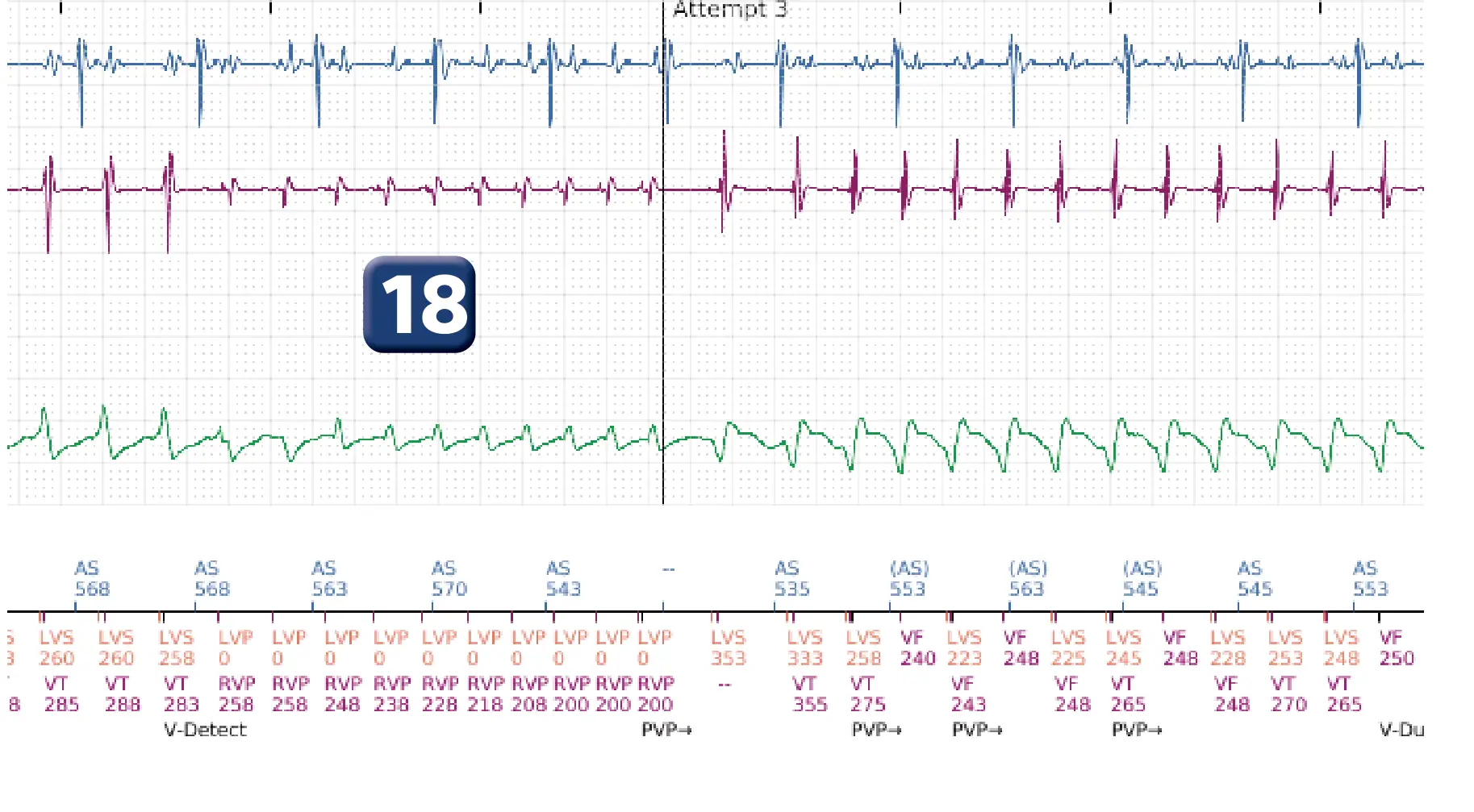 Boston Scientific ICD electrogram, segment 14 of 16 — Progression of therapies in the VT zone