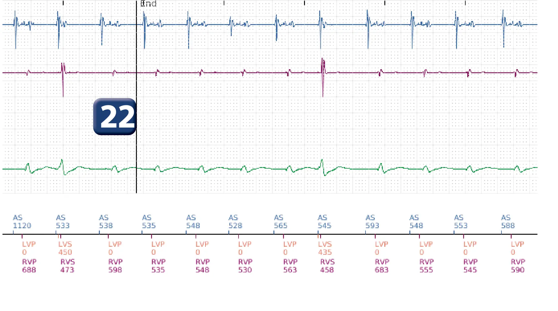 Boston Scientific ICD electrogram, segment 16 of 16 — Progression of therapies in the VT zone