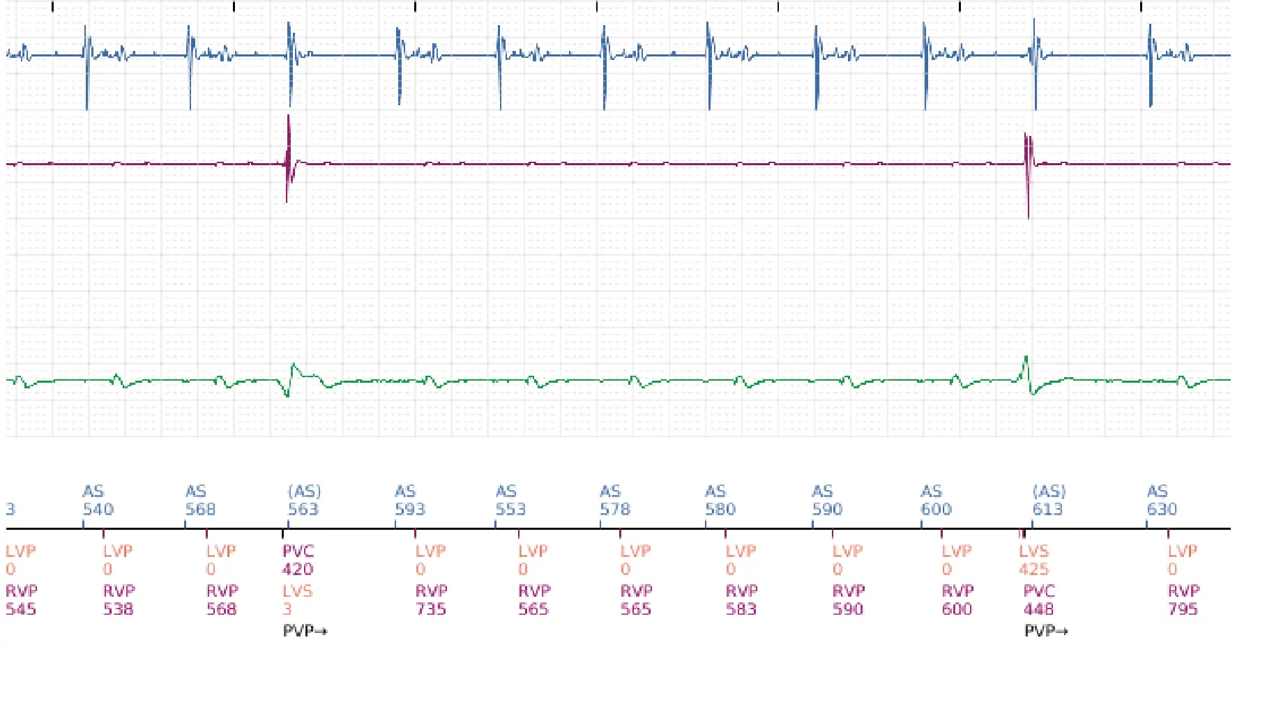 Boston Scientific ICD electrogram, segment 2 of 16 — Progression of therapies in the VT zone
