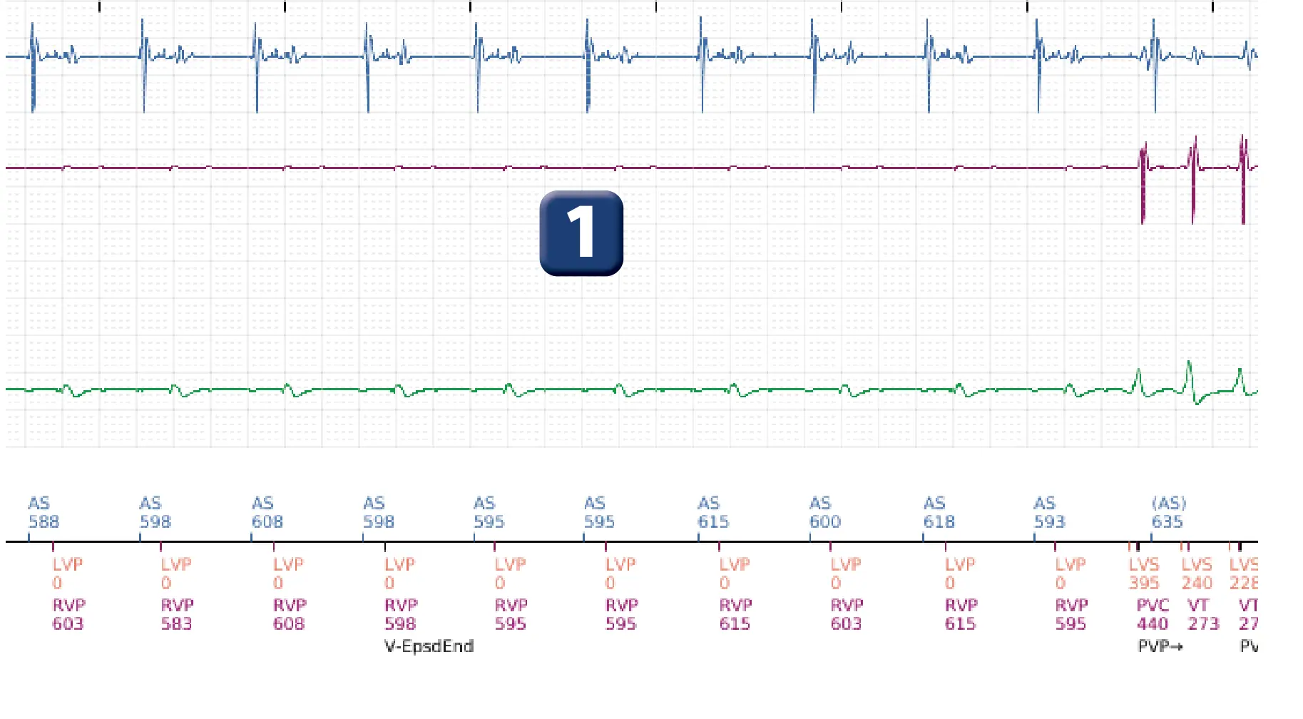 Boston Scientific ICD electrogram, segment 3 of 16 — Progression of therapies in the VT zone
