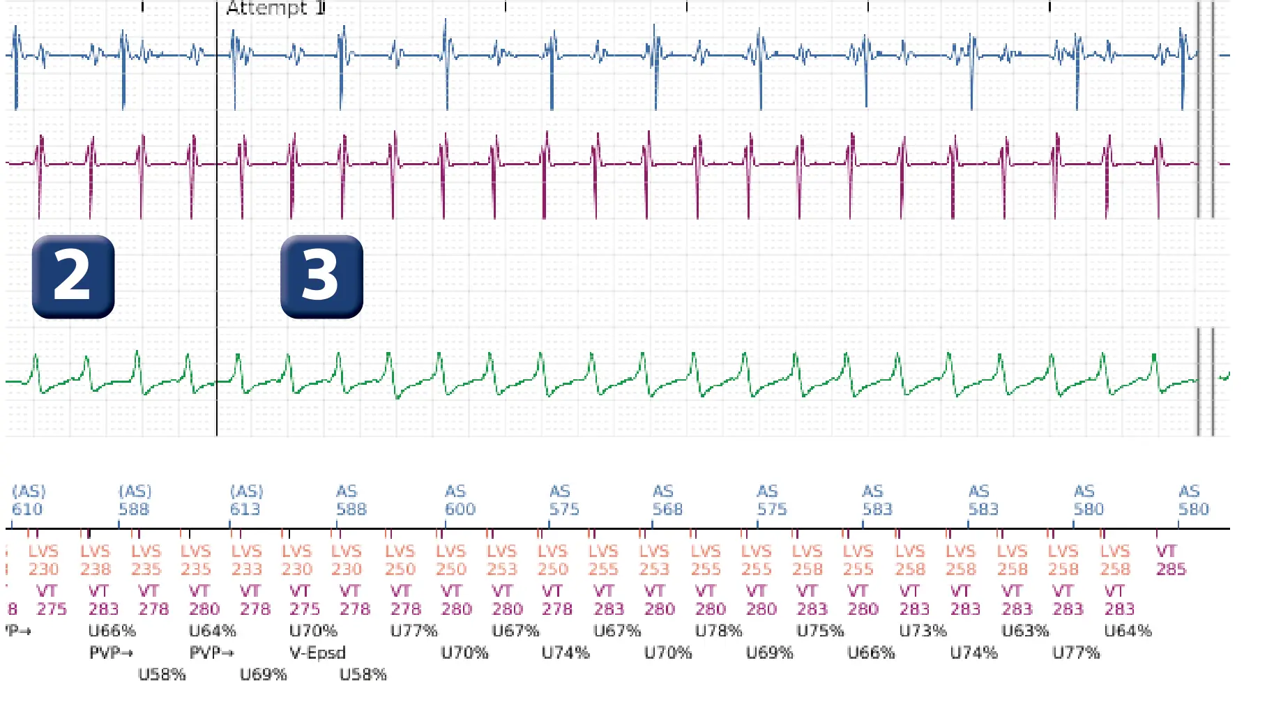 Boston Scientific ICD electrogram, segment 4 of 16 — Progression of therapies in the VT zone
