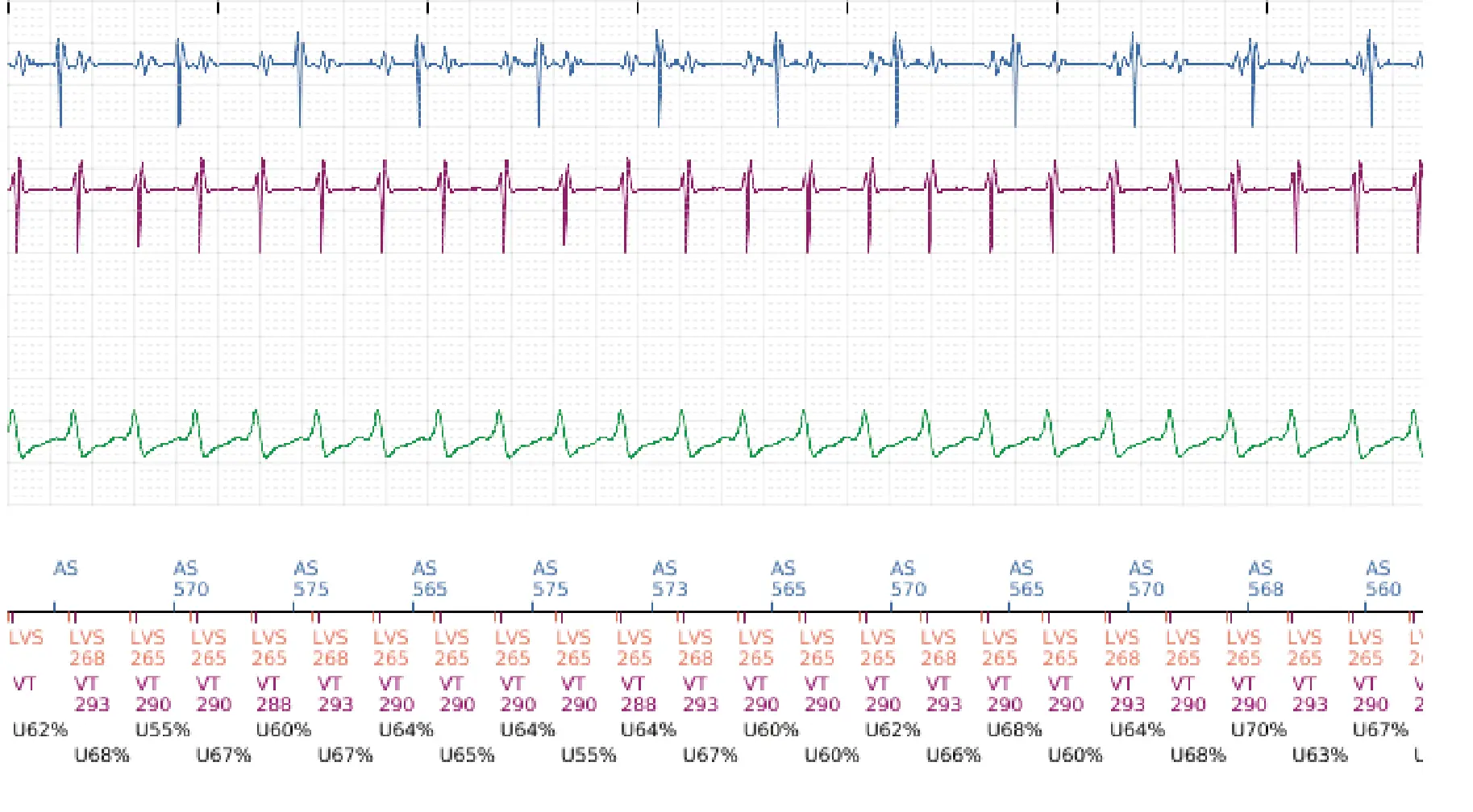 Boston Scientific ICD electrogram, segment 5 of 16 — Progression of therapies in the VT zone