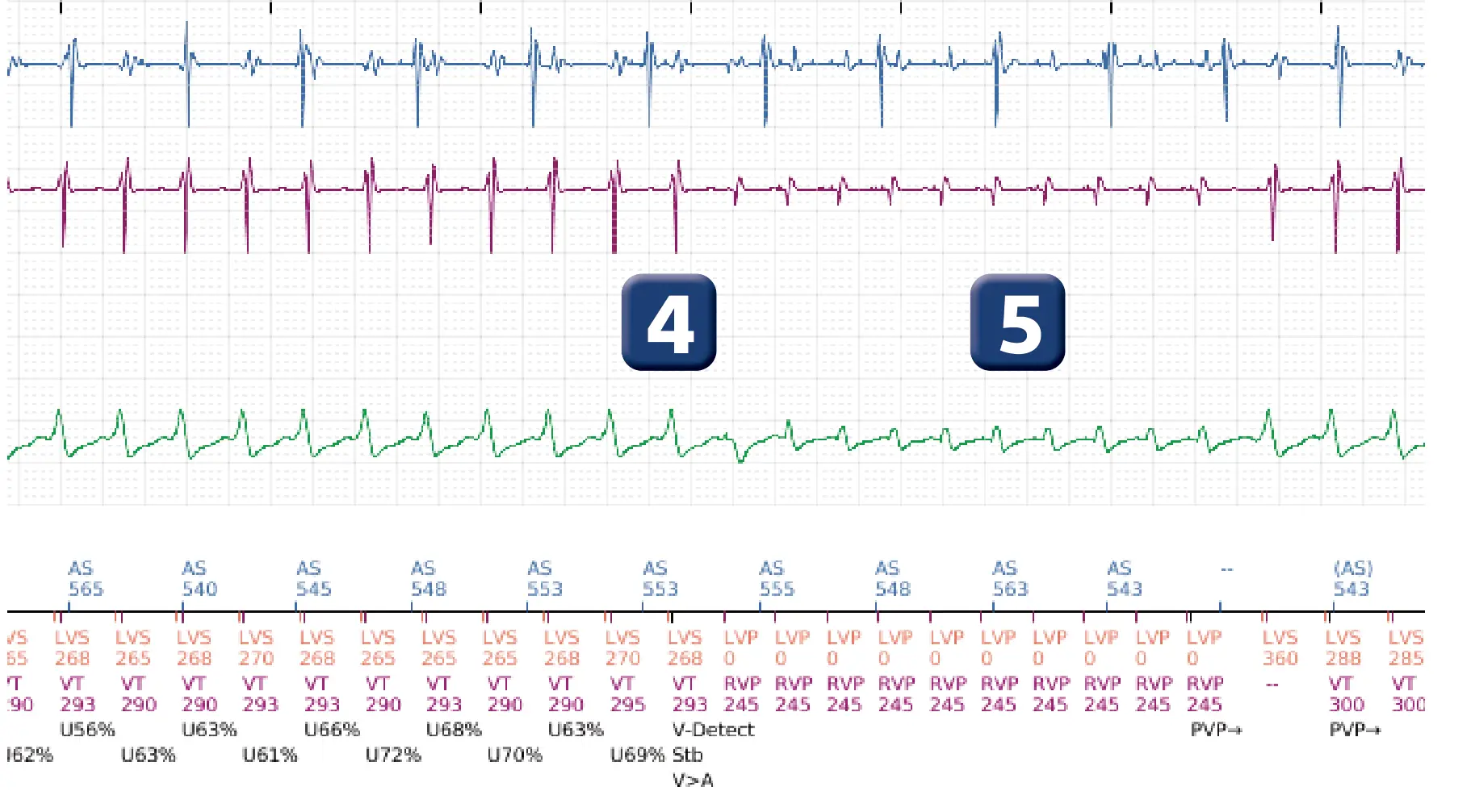 Boston Scientific ICD electrogram, segment 6 of 16 — Progression of therapies in the VT zone