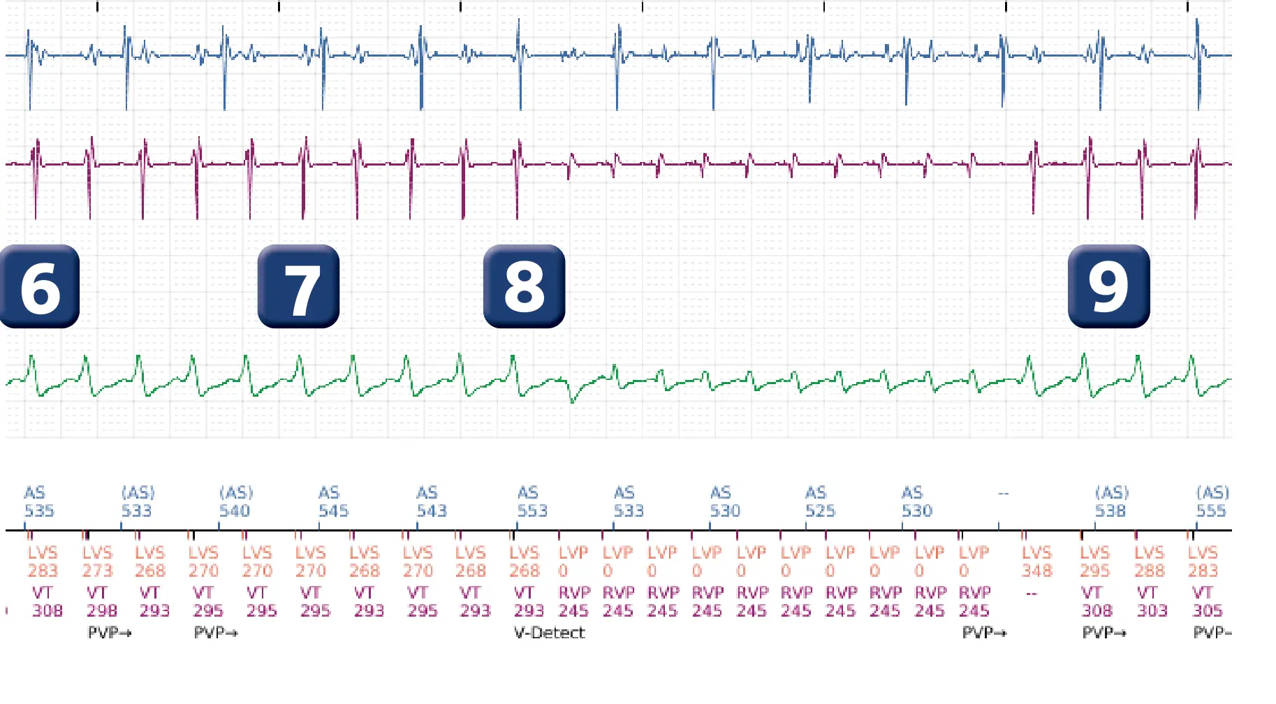 Boston Scientific ICD electrogram, segment 7 of 16 — Progression of therapies in the VT zone