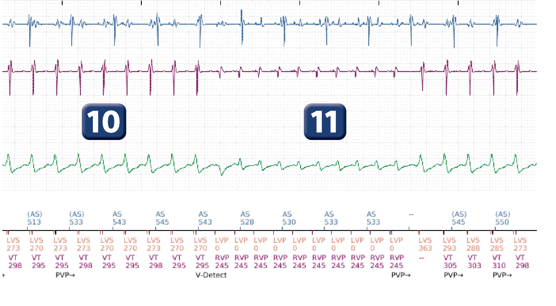 Boston Scientific ICD electrogram, segment 8 of 16 — Progression of therapies in the VT zone