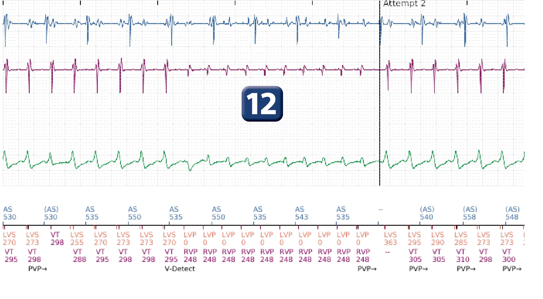 Boston Scientific ICD electrogram, segment 9 of 16 — Progression of therapies in the VT zone