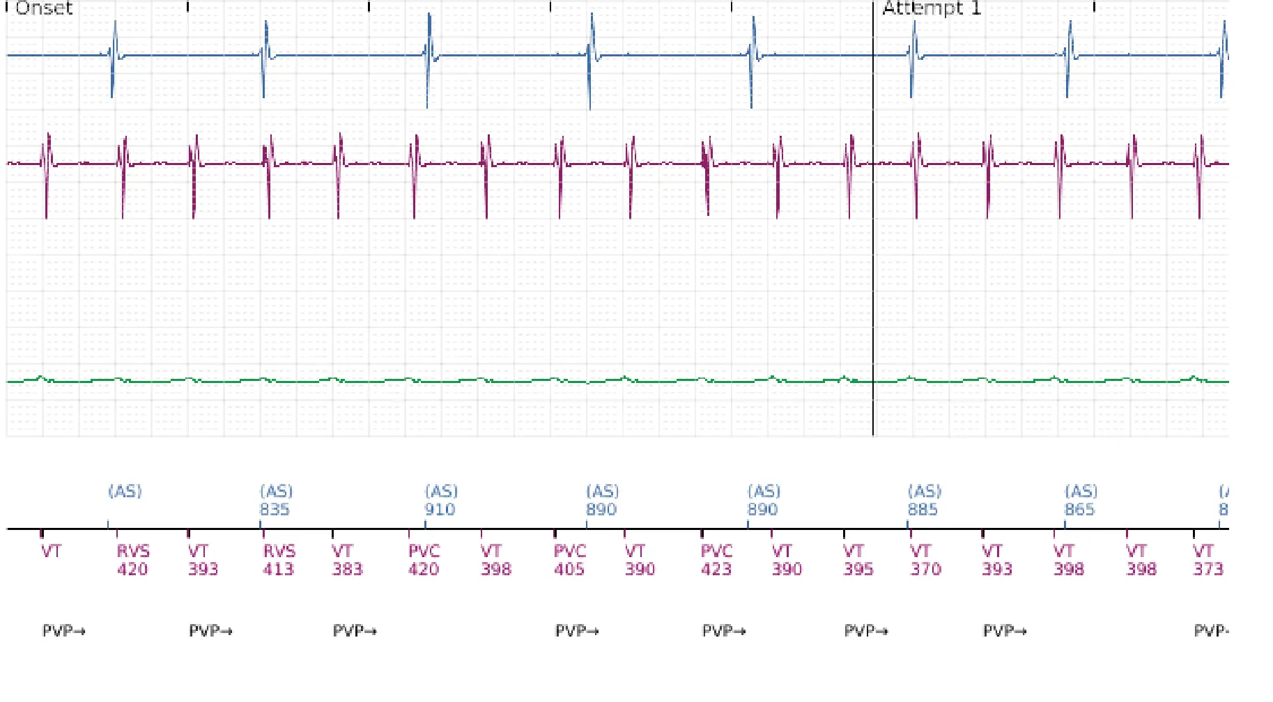 Boston Scientific ICD electrogram, segment 1 of 16 — Low-amplitude shock and acceleration of arrhythmia