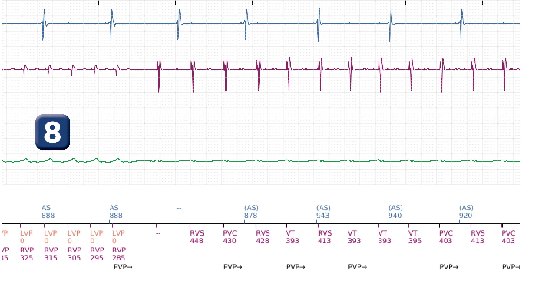 Boston Scientific ICD electrogram, segment 10 of 16 — Low-amplitude shock and acceleration of arrhythmia