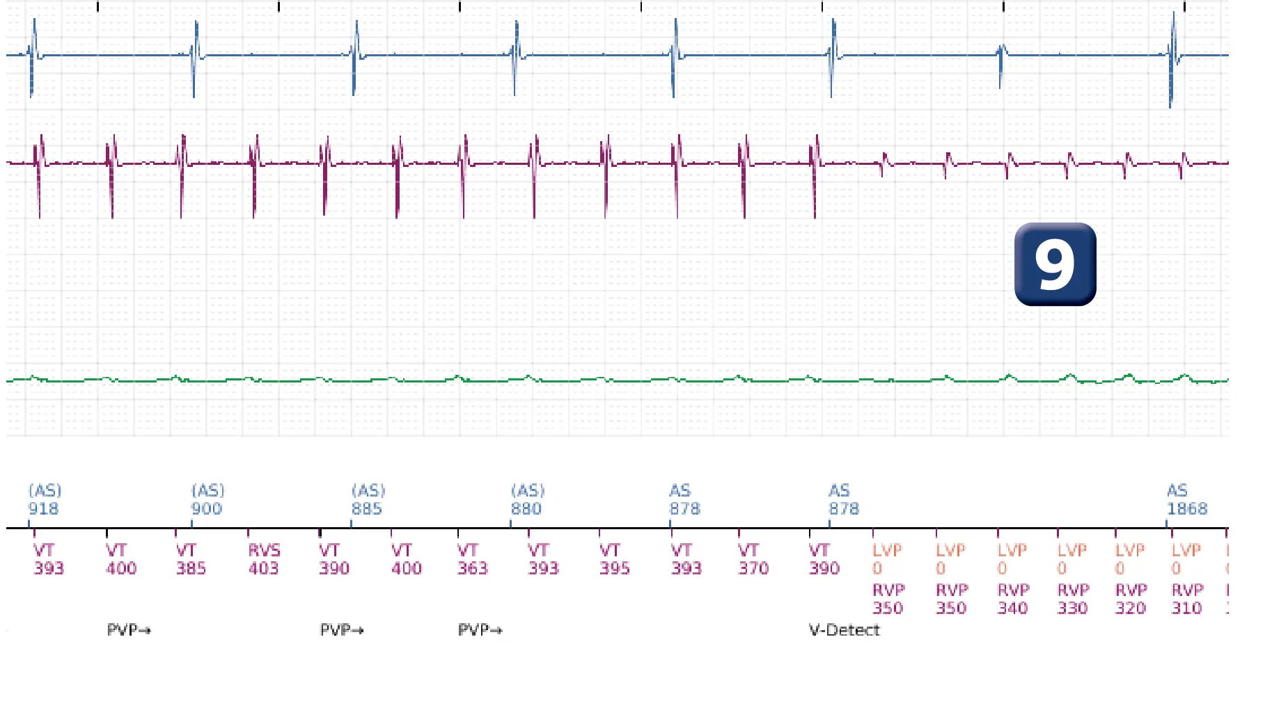 Boston Scientific ICD electrogram, segment 11 of 16 — Low-amplitude shock and acceleration of arrhythmia