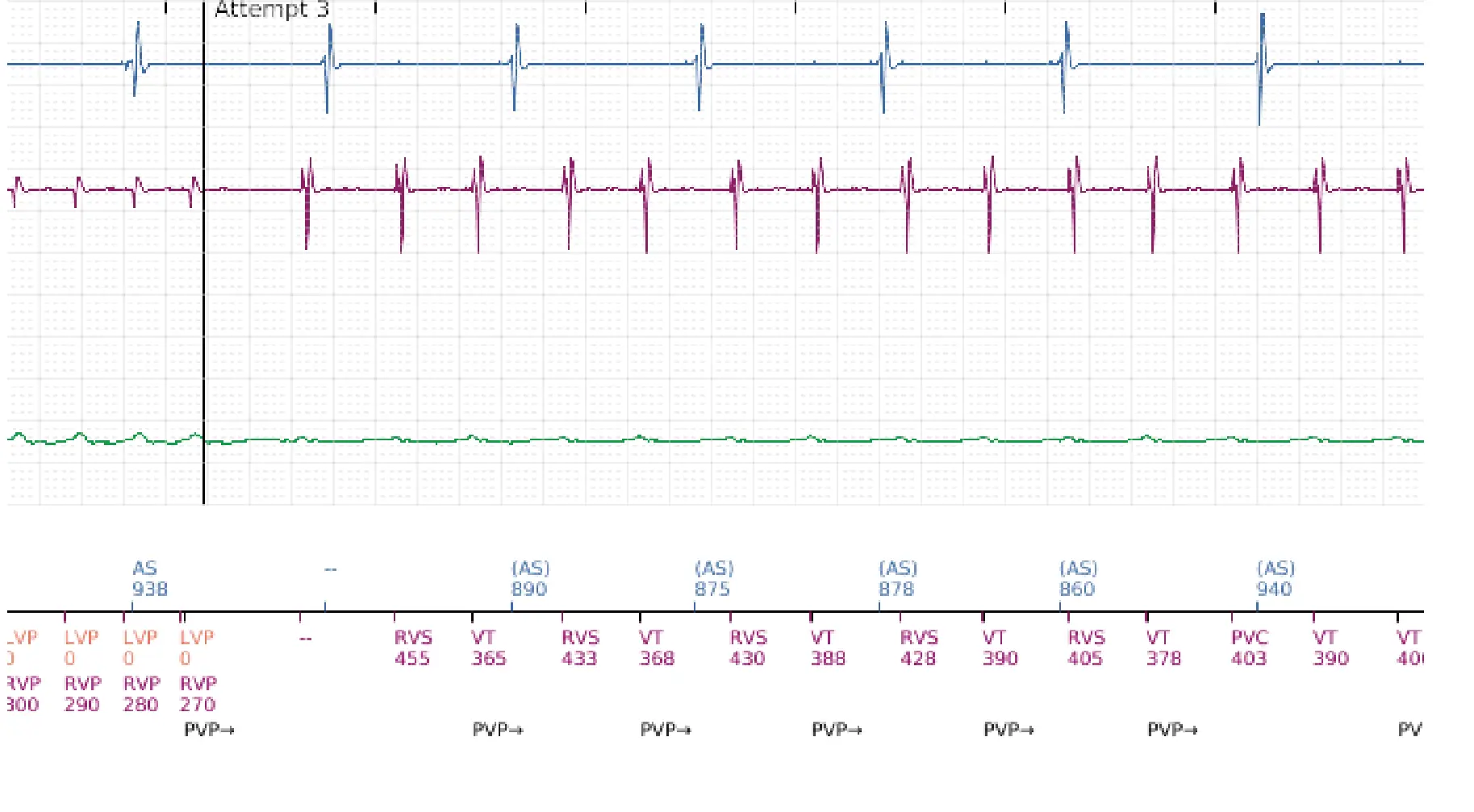 Boston Scientific ICD electrogram, segment 12 of 16 — Low-amplitude shock and acceleration of arrhythmia