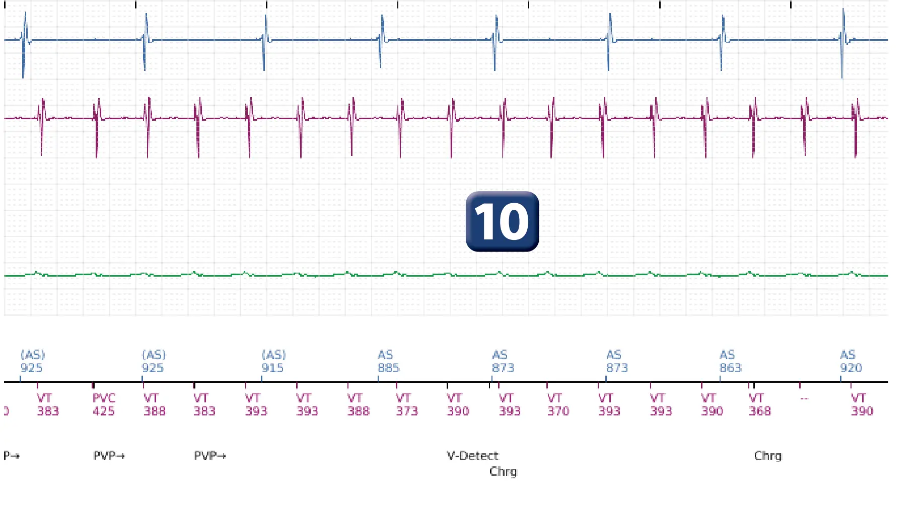 Boston Scientific ICD electrogram, segment 13 of 16 — Low-amplitude shock and acceleration of arrhythmia