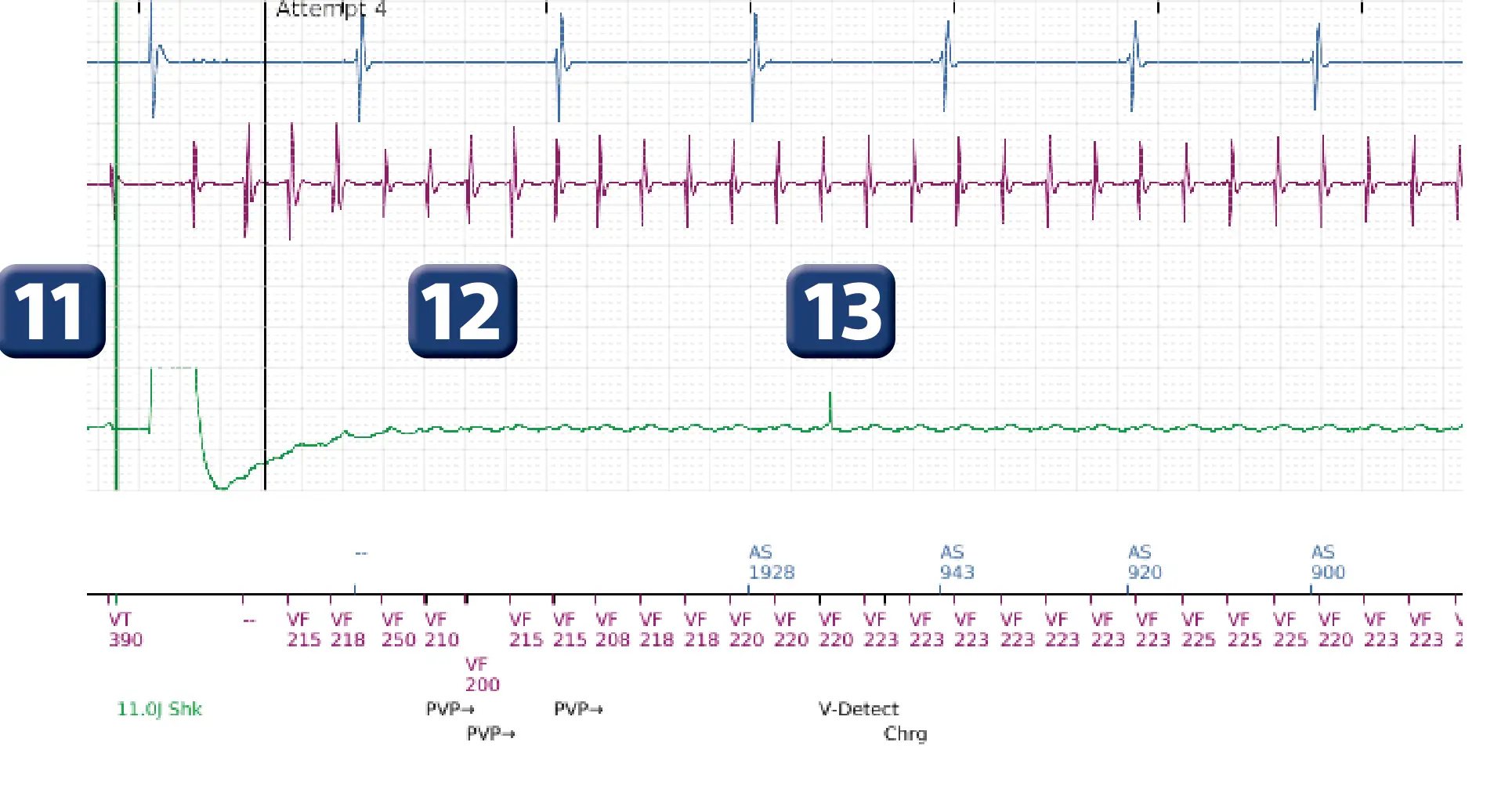 Boston Scientific ICD electrogram, segment 14 of 16 — Low-amplitude shock and acceleration of arrhythmia