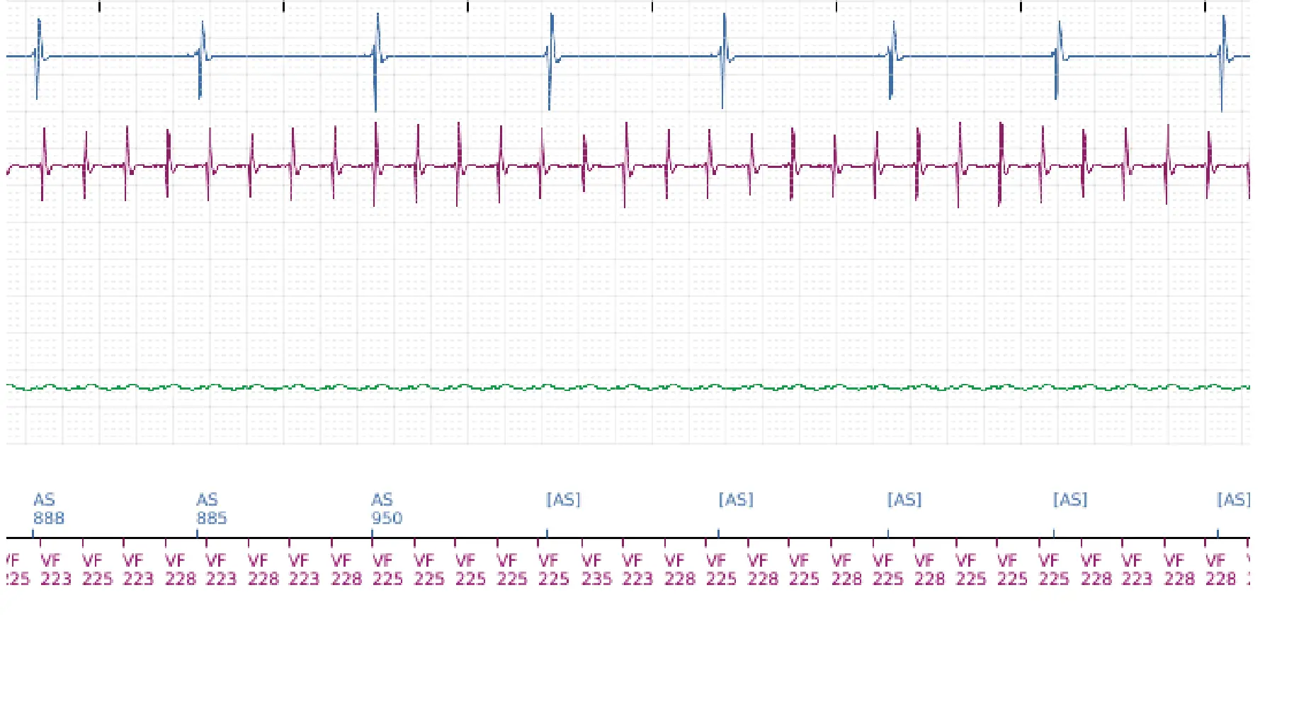 Boston Scientific ICD electrogram, segment 15 of 16 — Low-amplitude shock and acceleration of arrhythmia