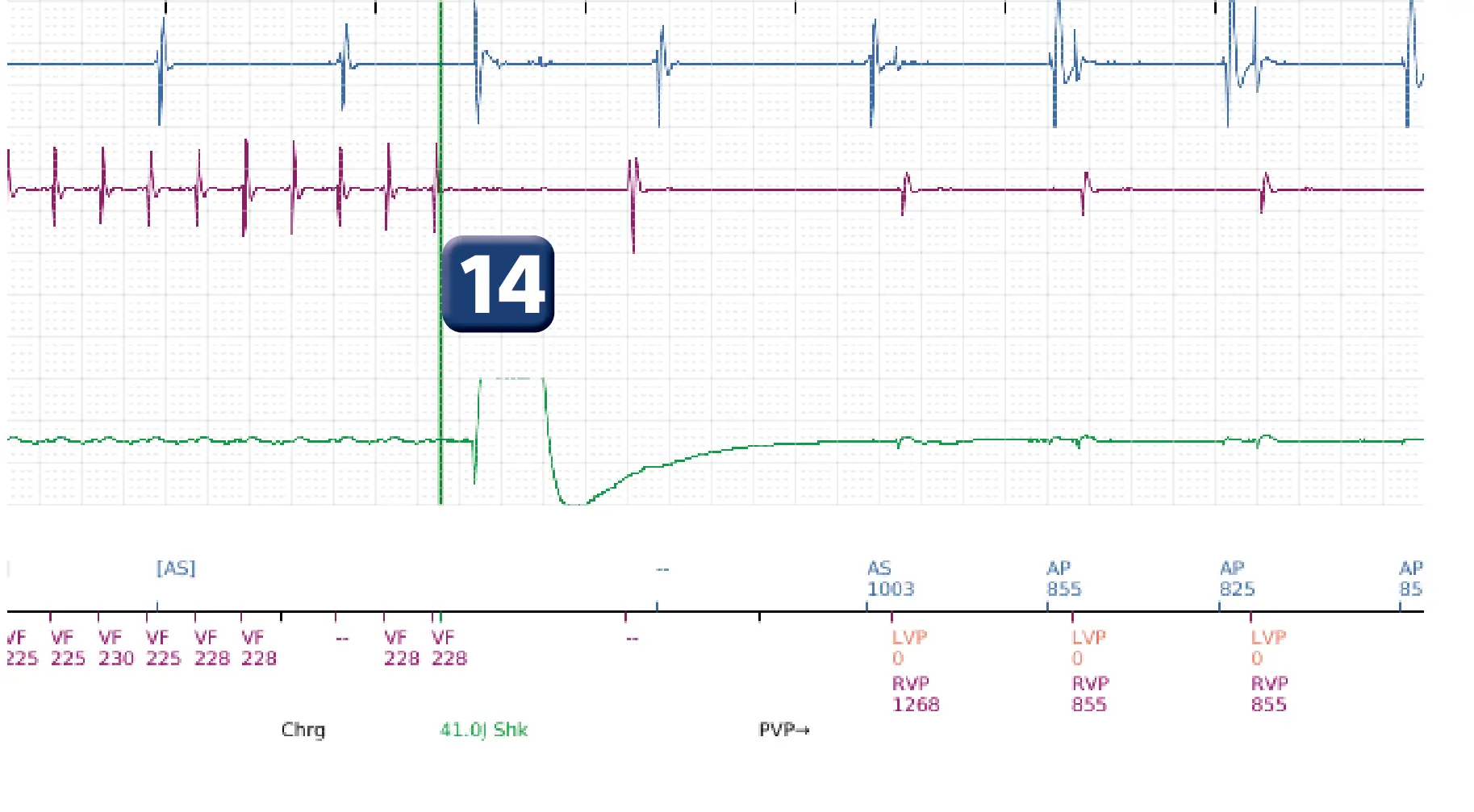 Boston Scientific ICD electrogram, segment 16 of 16 — Low-amplitude shock and acceleration of arrhythmia