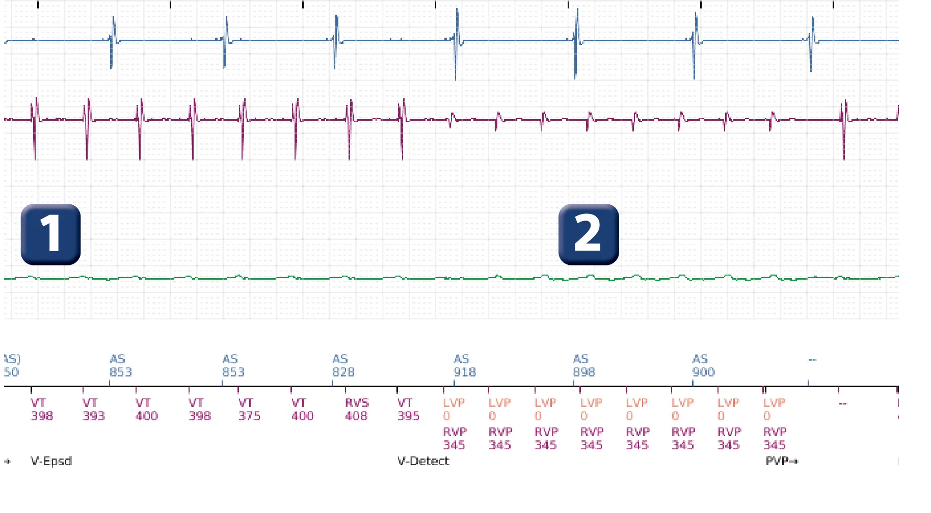 Boston Scientific ICD electrogram, segment 2 of 16 — Low-amplitude shock and acceleration of arrhythmia