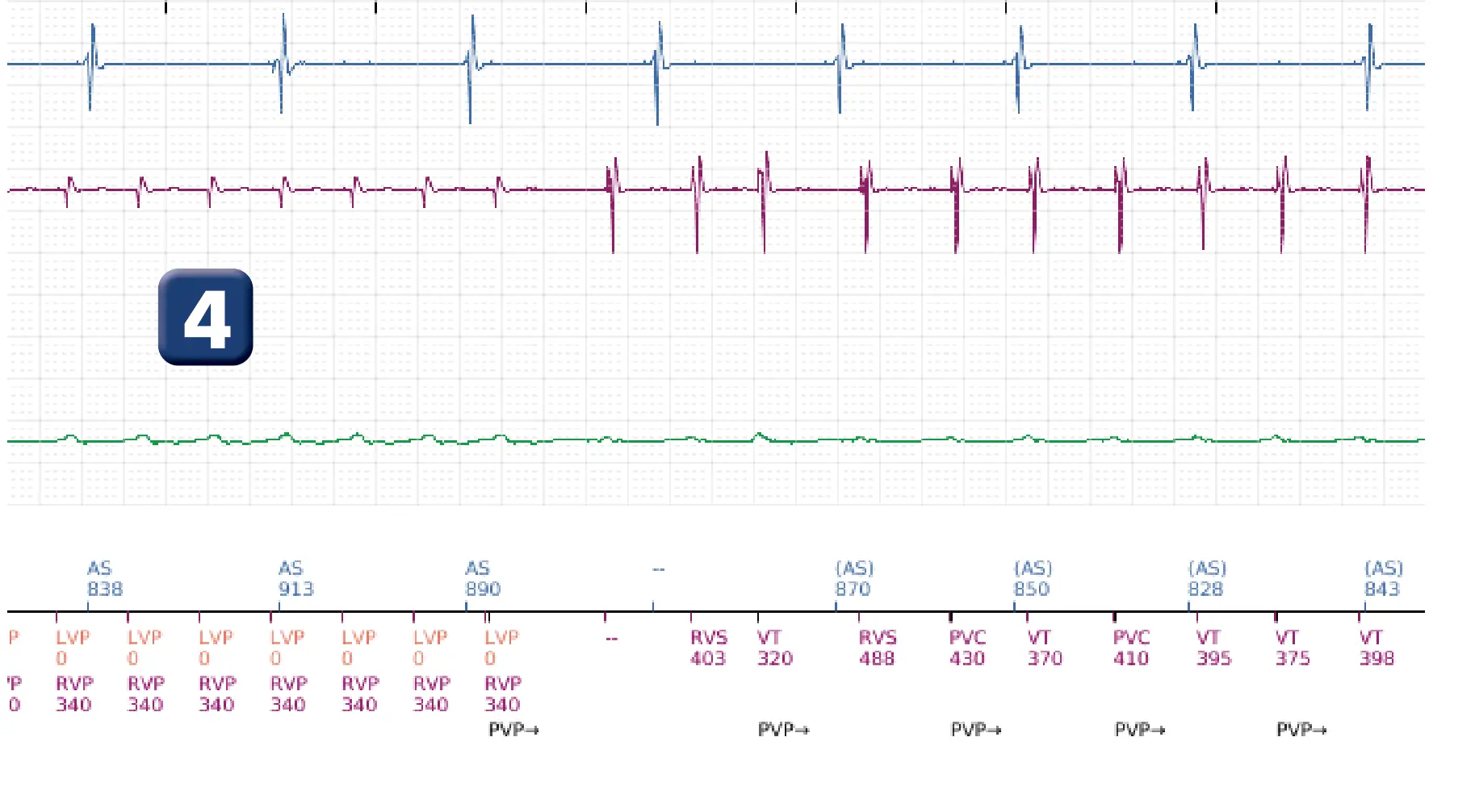 Boston Scientific ICD electrogram, segment 4 of 16 — Low-amplitude shock and acceleration of arrhythmia