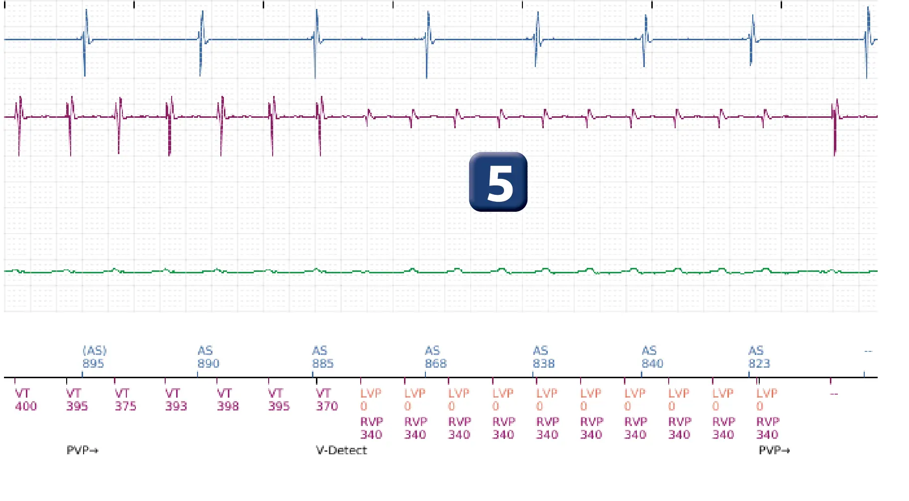 Boston Scientific ICD electrogram, segment 5 of 16 — Low-amplitude shock and acceleration of arrhythmia