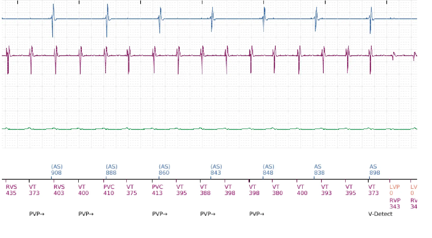 Boston Scientific ICD electrogram, segment 6 of 16 — Low-amplitude shock and acceleration of arrhythmia