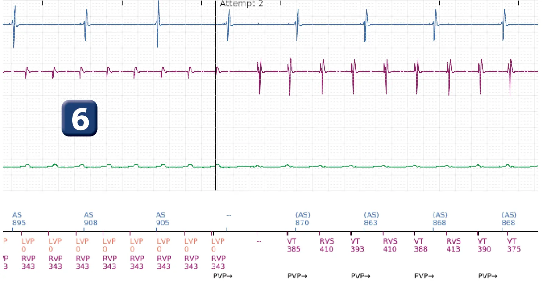 Boston Scientific ICD electrogram, segment 7 of 16 — Low-amplitude shock and acceleration of arrhythmia