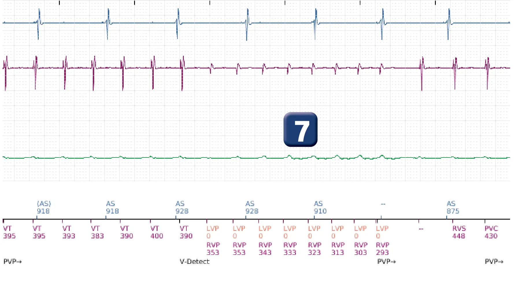 Boston Scientific ICD electrogram, segment 8 of 16 — Low-amplitude shock and acceleration of arrhythmia