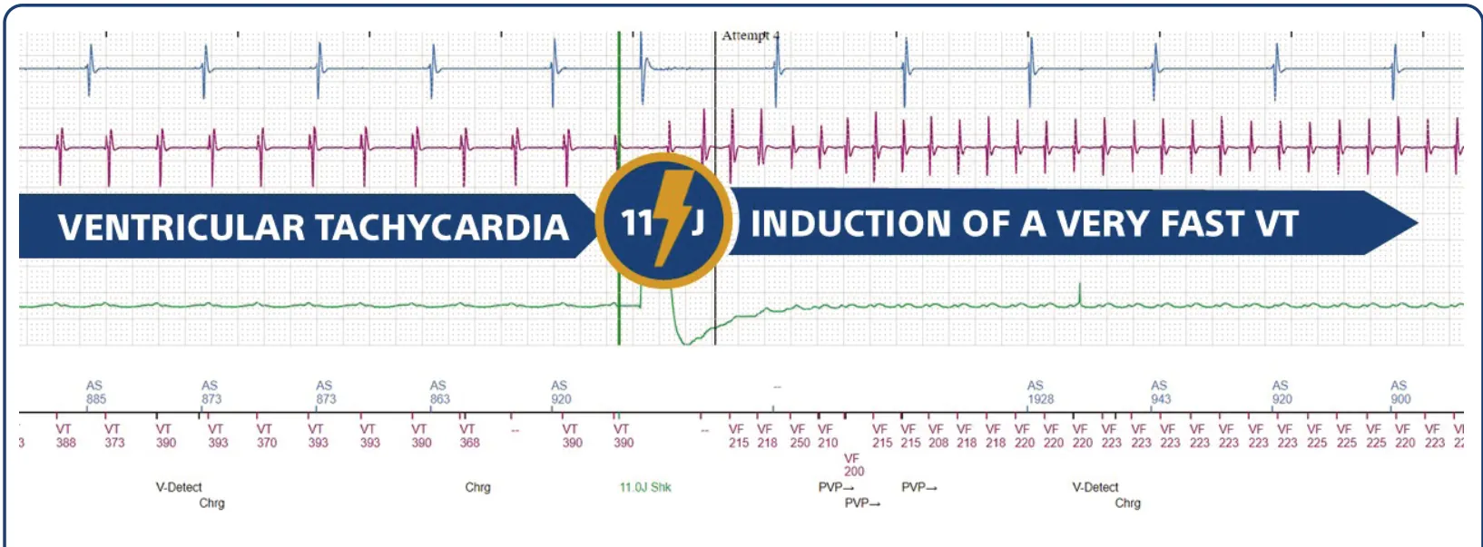 This figure shows how a medium-amplitude shock accelerates a monomorphic VT at 160 beats/minute into a very rapid ventricular flutter.