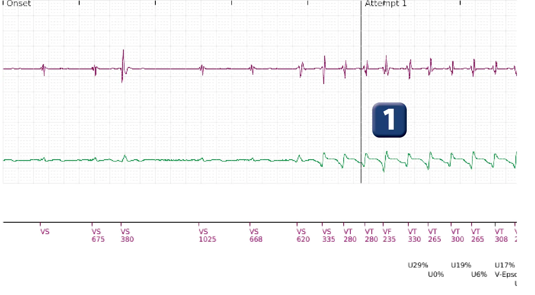 Boston Scientific ICD electrogram, segment 1 of 10 — Maximum output shock in the VT zone