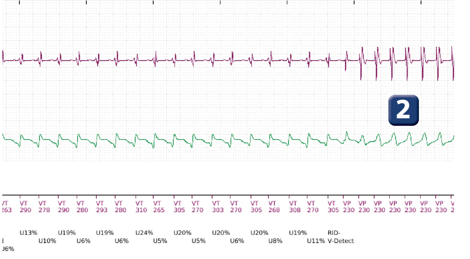 Boston Scientific ICD electrogram, segment 2 of 10 — Maximum output shock in the VT zone