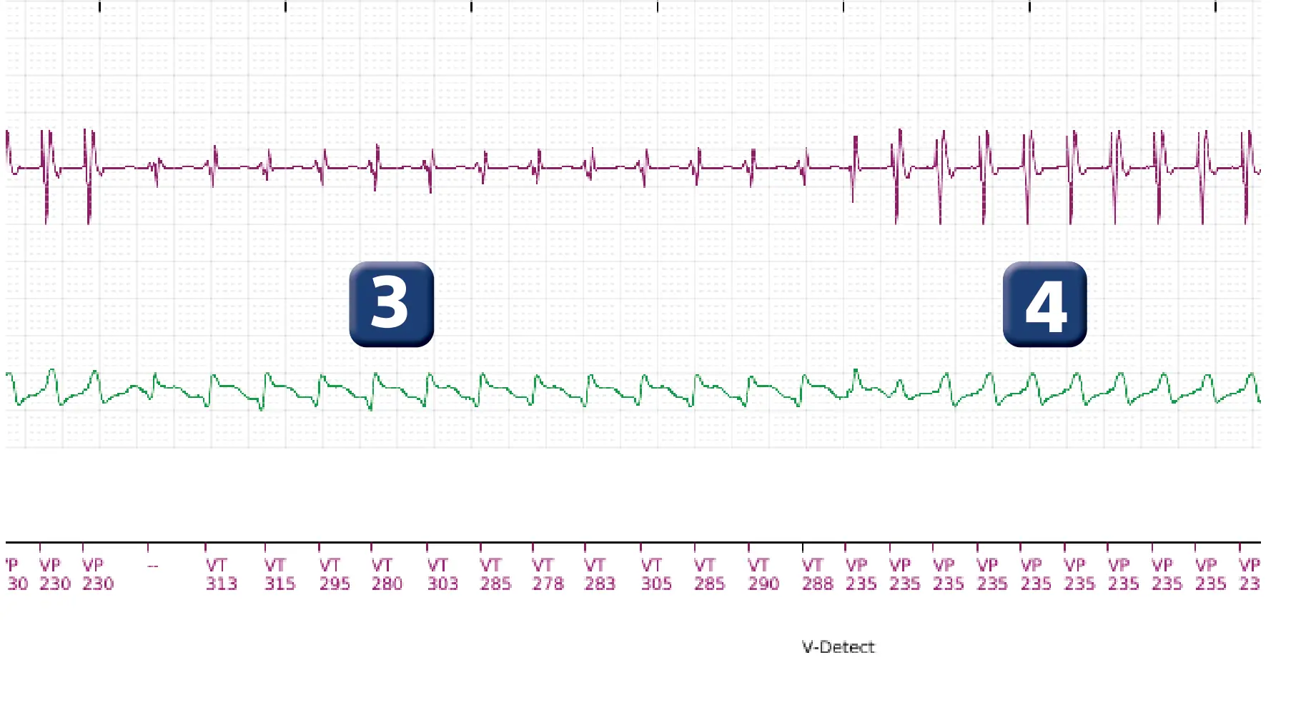 Boston Scientific ICD electrogram, segment 3 of 10 — Maximum output shock in the VT zone