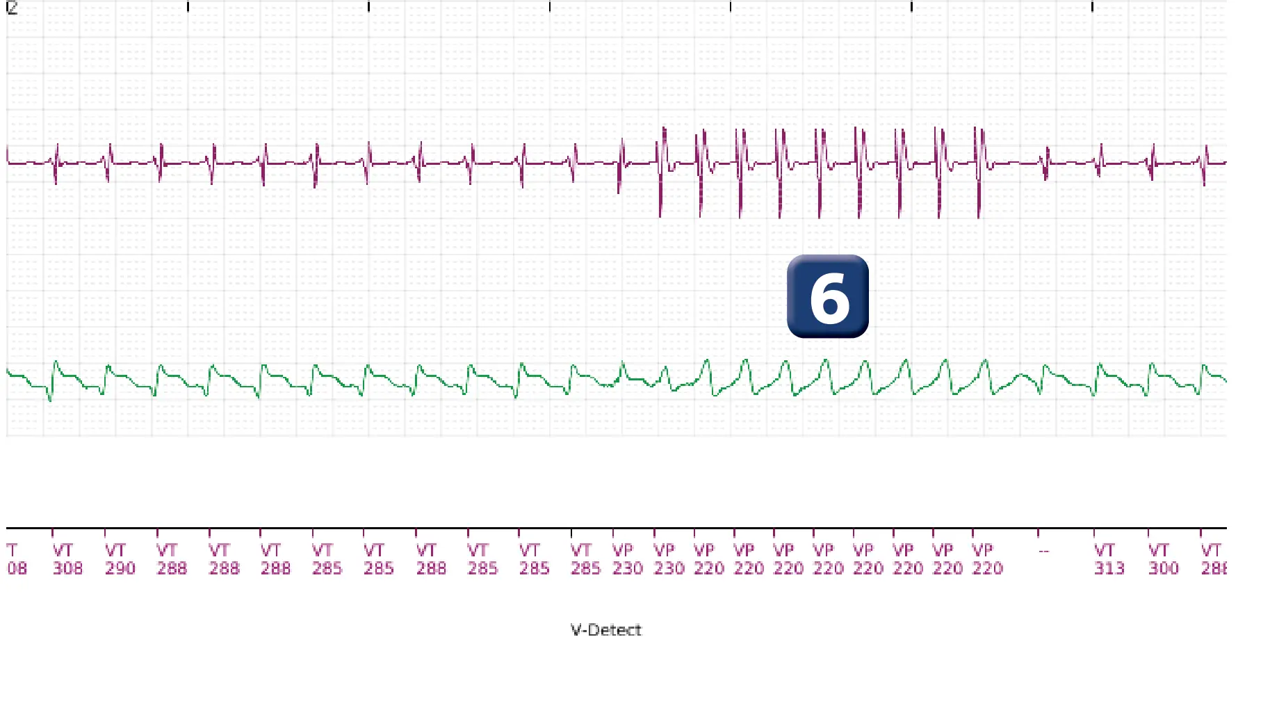 Boston Scientific ICD electrogram, segment 5 of 10 — Maximum output shock in the VT zone