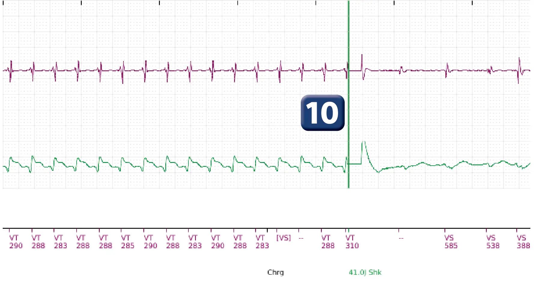 Boston Scientific ICD electrogram, segment 9 of 10 — Maximum output shock in the VT zone