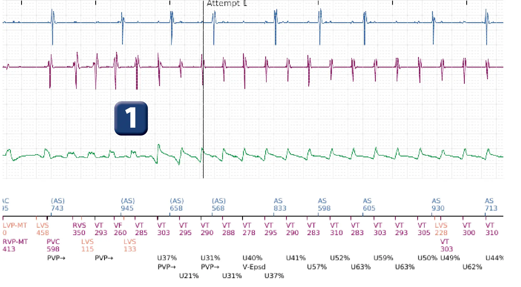 Boston Scientific ICD electrogram, segment 2 of 6 — Anti-tachycardia pacing in the VT zone with acceleration into the VF zone