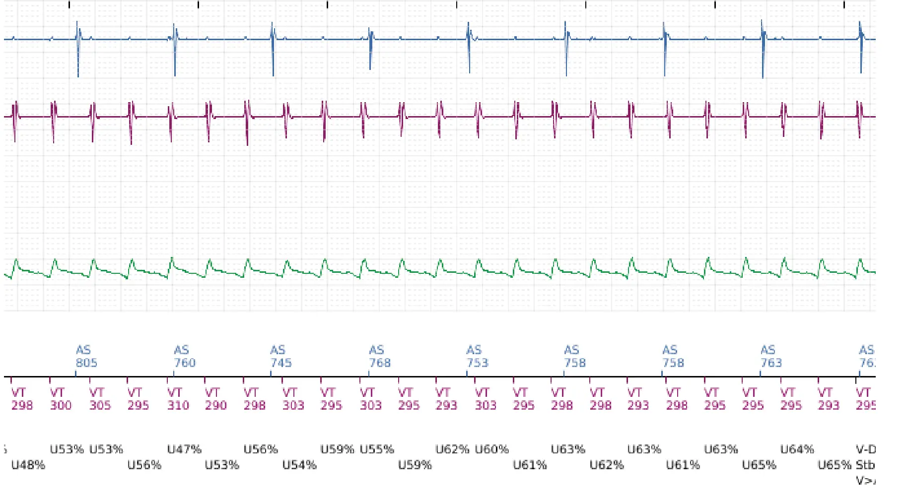 Boston Scientific ICD electrogram, segment 3 of 6 — Anti-tachycardia pacing in the VT zone with acceleration into the VF zone